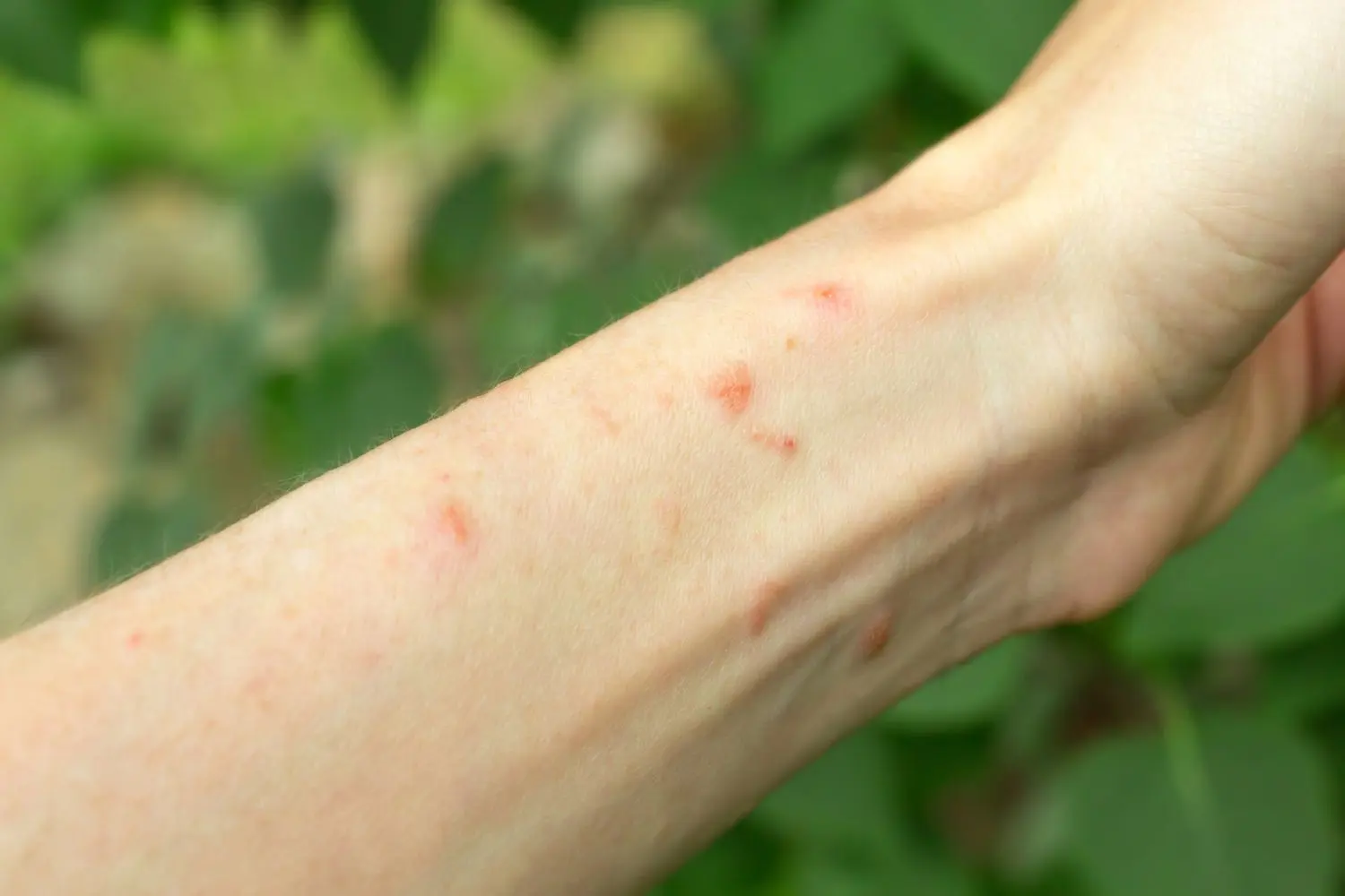 How to Get Rid of Poison Ivy Fast?